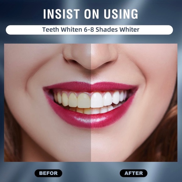 CHICY Teeth Whitening Kit with LED Light,Cooperate with New 35% Carbamid - Picture 3 of 7